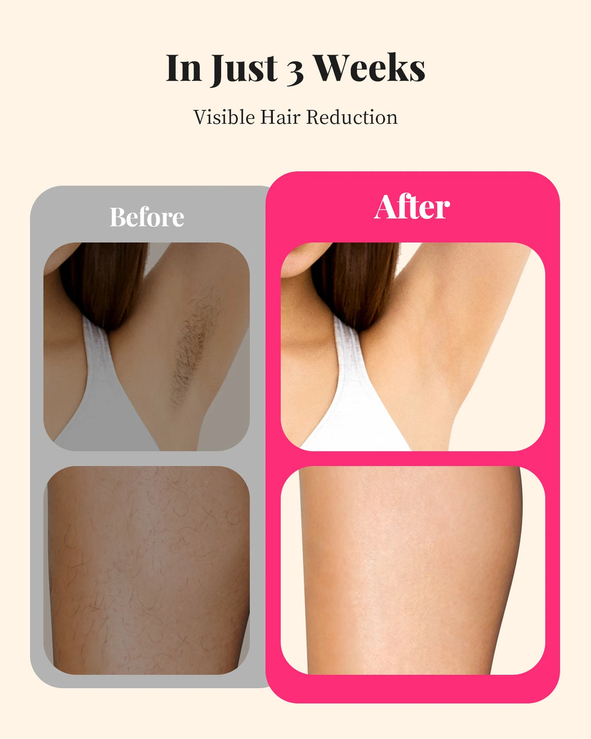 Totmizby IPL Hair Removal Device for Face Bikini and Body